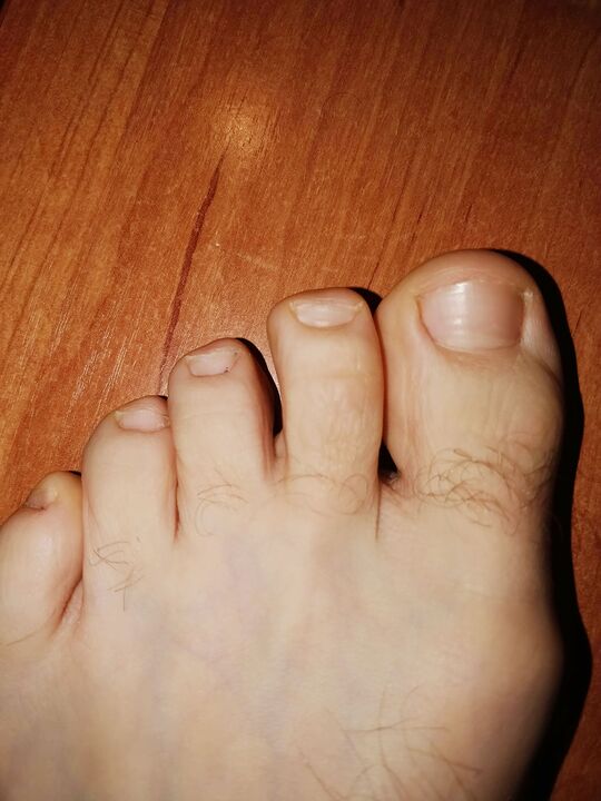 Pés sen fungo despois de aplicar a crema Marn exodermine brand